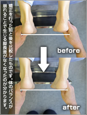 矯正を行った前と後を比較したものです。体のバランスが崩れることで生じる脚長差がなくなったのが分かります。